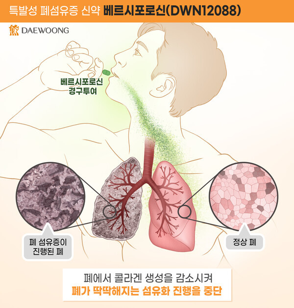 베르시포로신 작용 기전. 사진= 대웅제약
